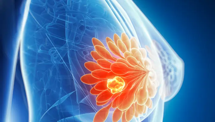 ब्रेस्ट कैंसर के लक्षण(Brest Cancer ke laxan): समय पर पहचान, जीवन की रक्षा 2 Untitled design 1 1