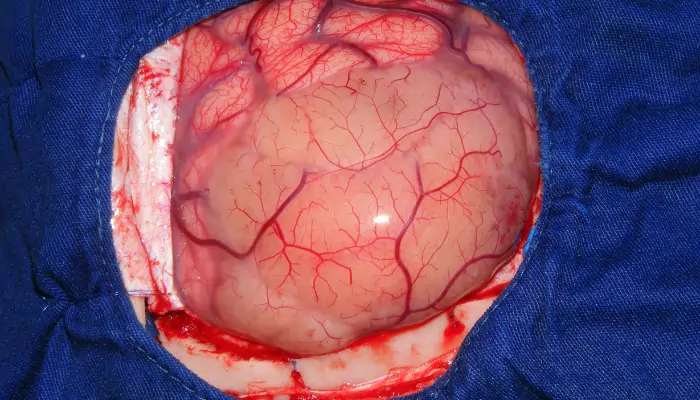 Brain Tumor Kya Hota Hai: Dimaag ke Tumor ki Poori Jaankari 2 h 1 2