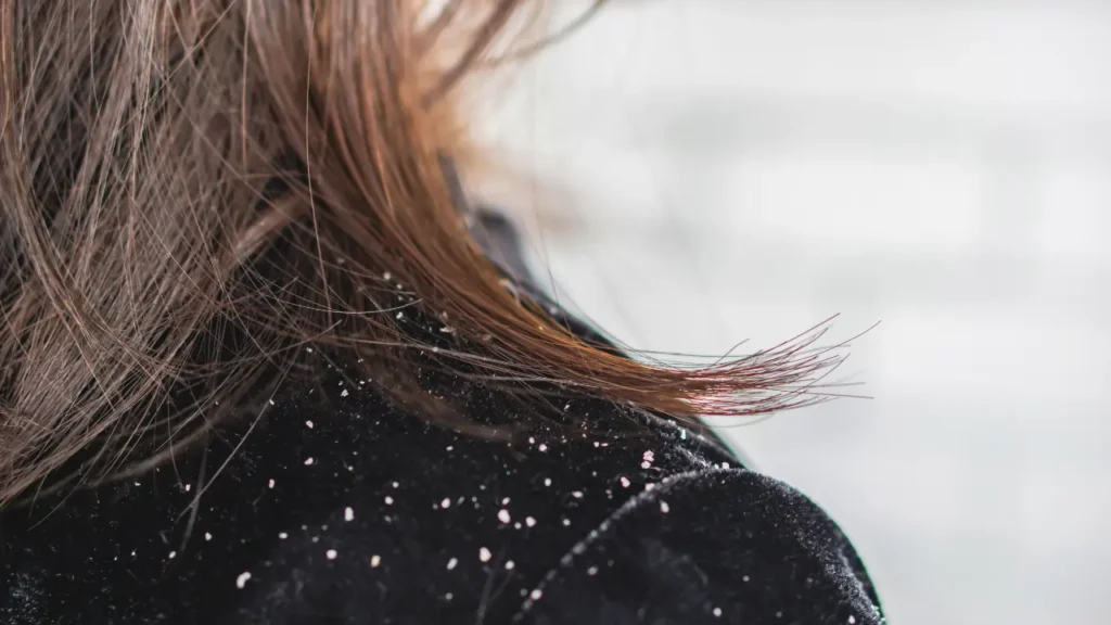 Kya Curd Aur Lemon Se Dandruff Door Ho Sakta Hai? Jaaniye Sab Kuch 1 Dandruff