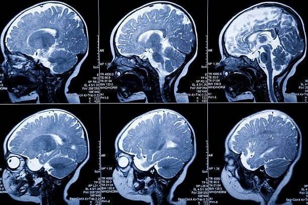 MRI Report Kaise Padhein?