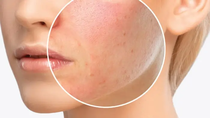 Allergic Reactions: Lemon Water 