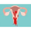 Menorrhagia